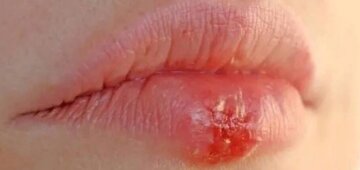 Герпес, кадр из видео