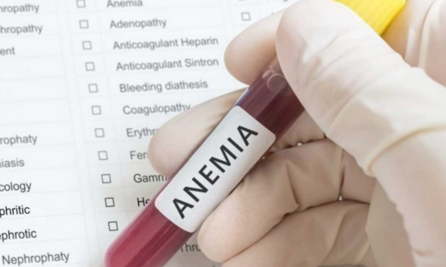Дефіцит заліза в організмі, анемія, зображення з вільних джерел