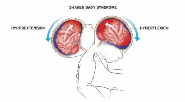 Shaken baby syndrome / фото: Х