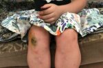 фото дівчинки, побитої поліцейськими - Facebook