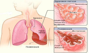 Пневмония: zokb.org.ua