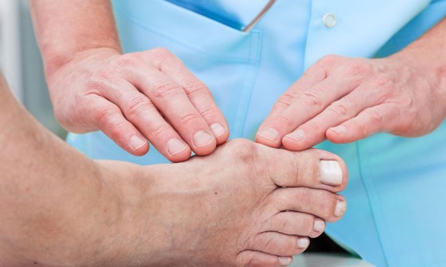 Избавиться от косточки на ноге раз и навсегда: действенный рецепт от медика