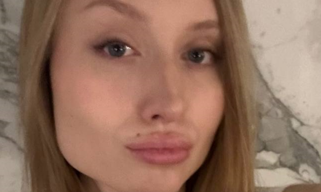 Дівчина з невдалими "уколами краси", фото із соцмереж