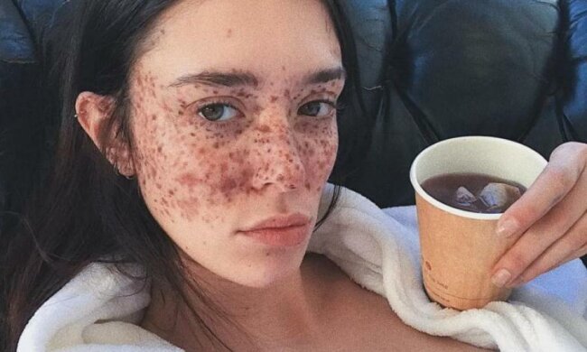 Модель з неймовірними веснянками підкорила Instagram