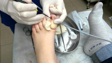 Операция по удалению вросшего ногтя, сайт "Nail Clinic"