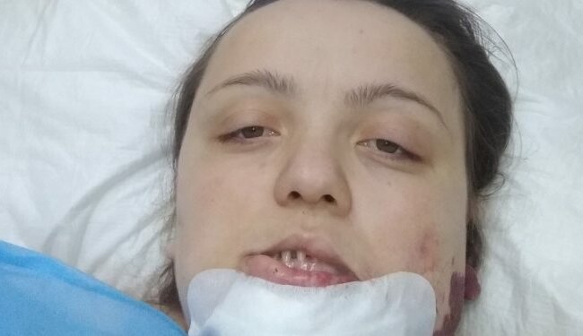 Родимое пятно поставило под угрозу жизнь многодетной матери: "Позади три операции, впереди - еще две"