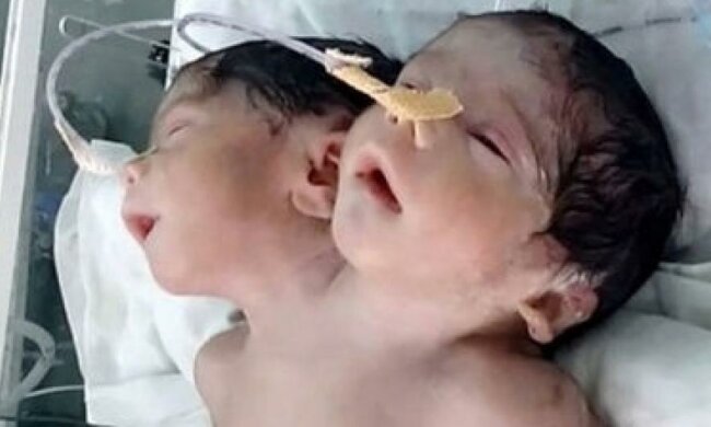 Двухголовый ребенок умер после рождения