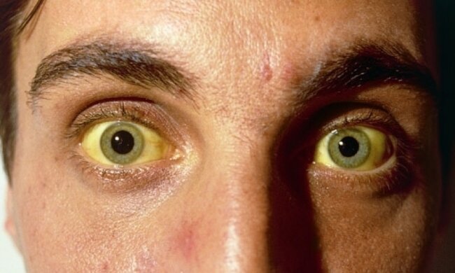 Чотирьох львів'ян госпіталізували з гепатитом