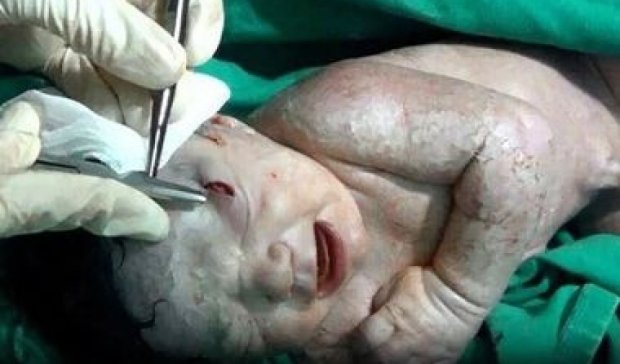 Сирийская девочка родилась с осколком в голове (фото)