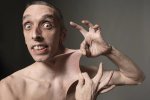 Гаррі Тернер: володар найеластичнішої шкіри у світі