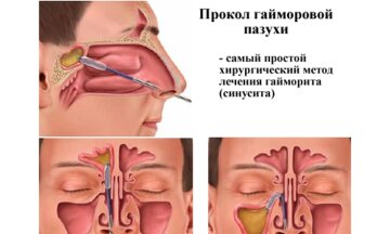 прокол гайморової пазухи