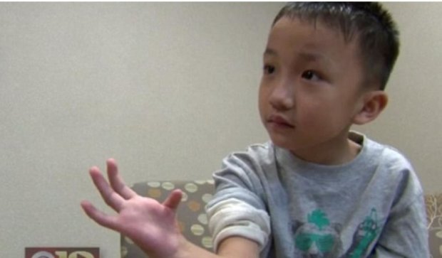  Хирурги отрастили ребенку большой палец на руке