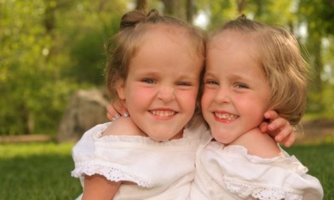 Как выглядят и чем живут самые знаменитые сиамские близнецы через 13 лет после разделения: фото