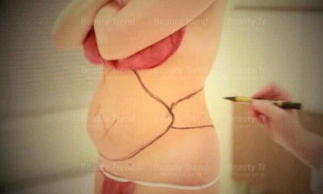 Лікарі пропонують лікувати болі у спині жиром із живота