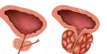 Аденома, http://urofront.ru/adenoma-prostaty/