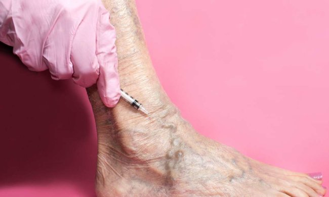 Варикозне розширення вен: коли пора йти до лікаря