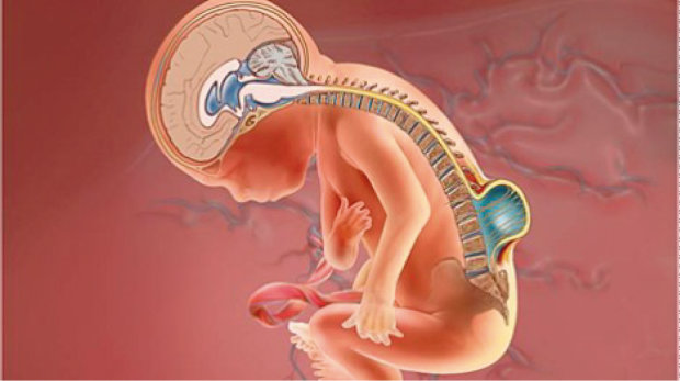 Розщеплення хребта: медики навчилися лікувати рідкісну аномалію в утробі матері