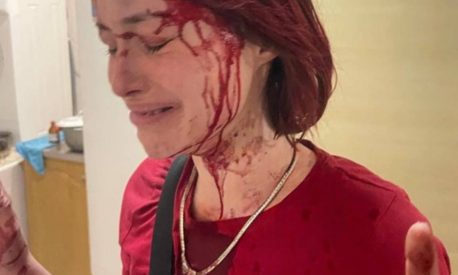 Девушка, избитая работником ТЦК. Фото: "Думская"