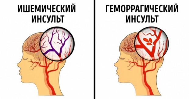 Марихуана инсульт конопля руками