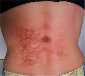 Синдром "поджаренной кожи": фото Actas Dermo-Sifiliográficas