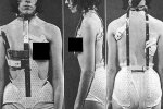 Лечение сколиоза, фото из свободных источников