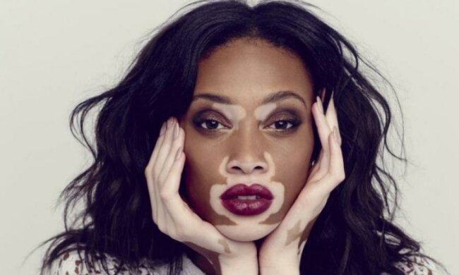 Хвороба не завада: відома модель шокувала  еротичними фото