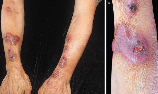 Инфекция на руках, фото: The New England Journal of medicine