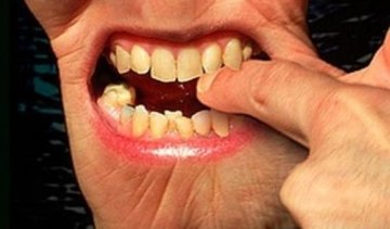 За откушенное ухо депутату «светит» 2 года тюрьмы