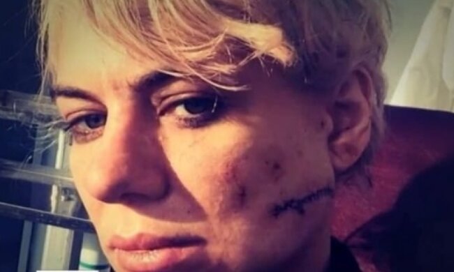 Хеллоуинские забавы: в ночном клубе Киева девушке порезали лицо (видео)