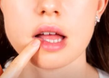 Герпес. Фото: скрин Ютуб