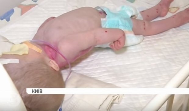 Київські лікарі ледь не залікували немовля до смерті