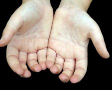 Груба шкіра на долонях є першою ознакою раку