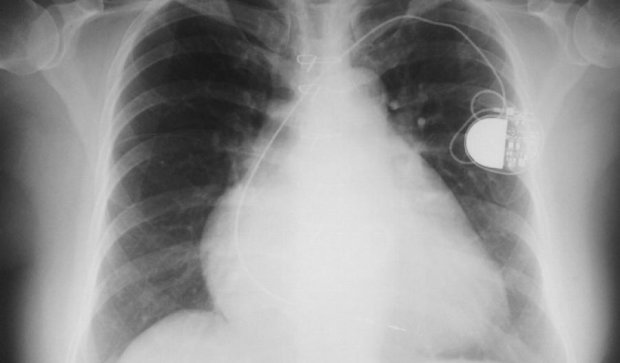 Системы электронного отслеживания опасны для людей с кардиостимуляторами