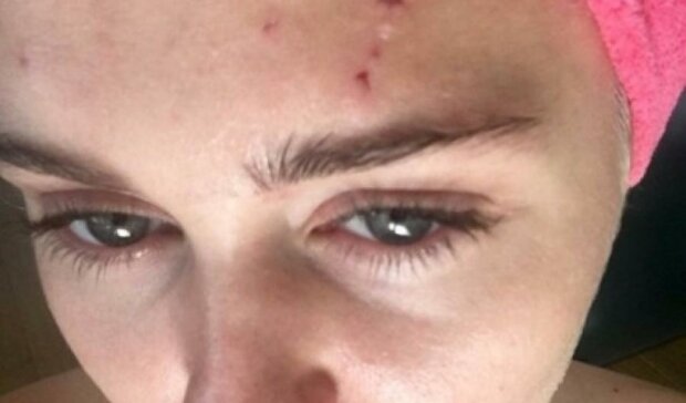 Майлі Сайрус роздряпали лице (фото)