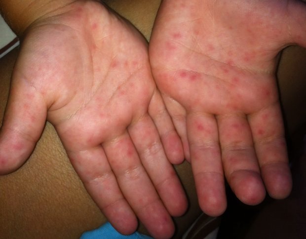 Аллергия и сыпь при кори отличие