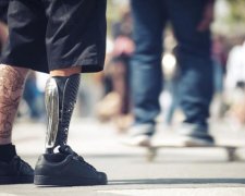 Лікарі пришили ногу задом наперед: вигляд не дуже, зате зручно