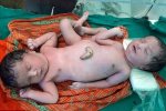 В Індії народились сіамські близнюки з однією парою ніг
