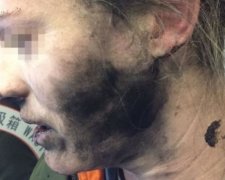 Вибухові навушники спалили обличчя пасажирці літака