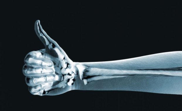 Нанотехнології допоможуть виявити переломи кісток