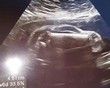 Будущий отец увидел на УЗИ жены автомобиль