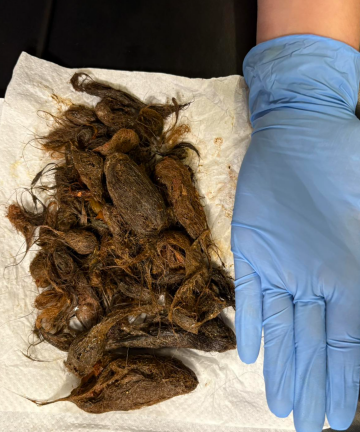 Волосся в шлунку дитини, фото з соцмереж