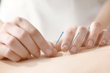 Мучительные симптомы менопаузы предложили лечить иглами