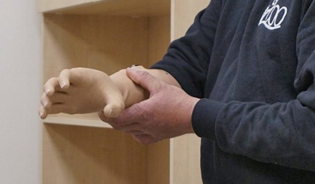 Біонічний протез руки вперше встановили в Одесі (фото)