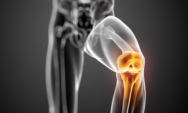 Атлас на коліна: імплант-амортизатор позбавить артрозу