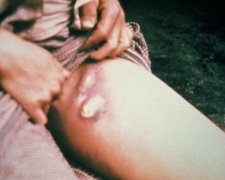 Росії загрожує епідемія чуми