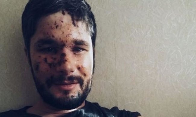 Покалічений під Авдіївкою британець розповів про злощасний обстріл