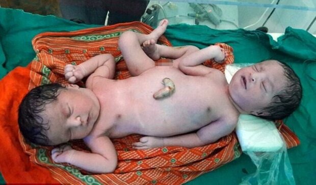 В Индии родились сиамские близнецы с одной парой ног