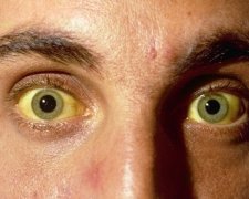 Чотирьох львів'ян госпіталізували з гепатитом