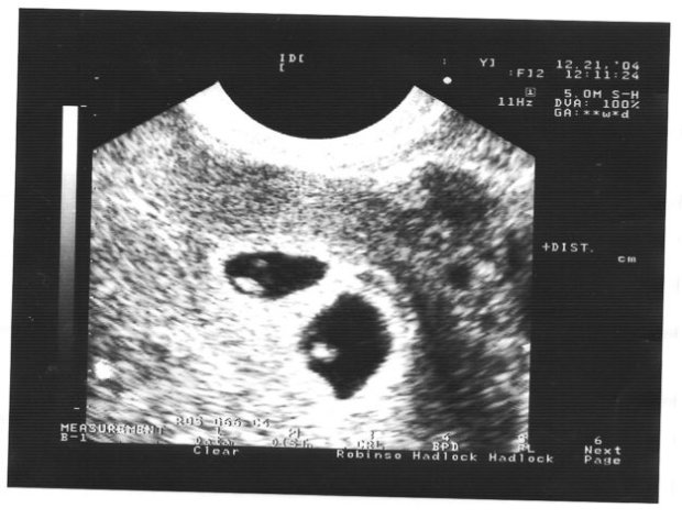 11 неделя многоплодной беременности
