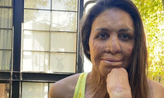 Instagram/Turia Pitt